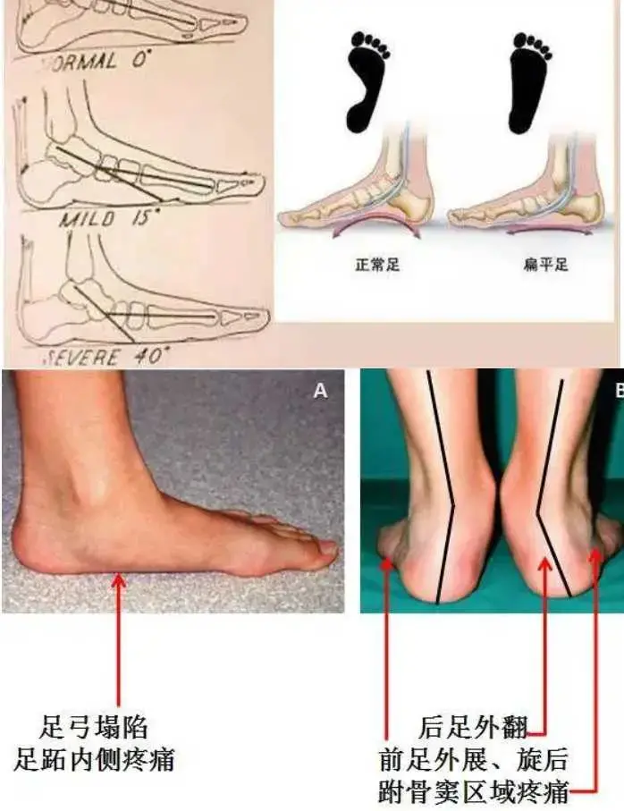 张美玲 扁平足 精准评估与处理方案